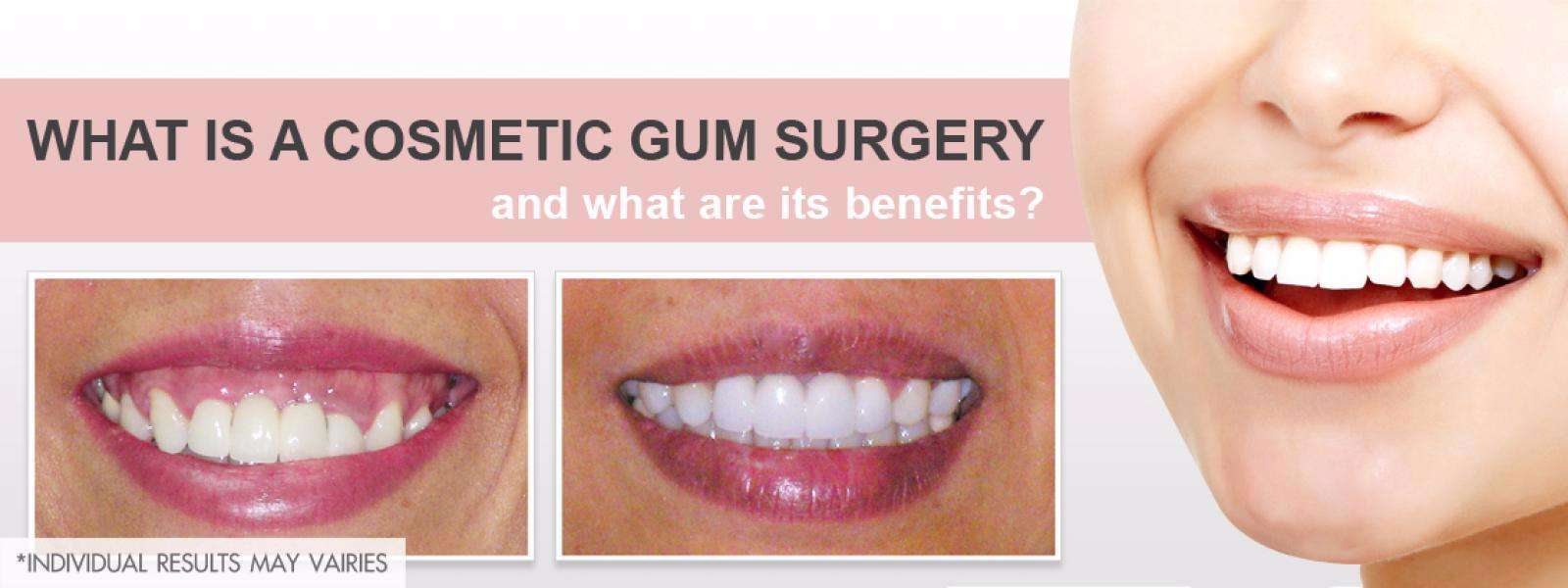 What is a cosmetic gum surgery and what are its benefits?