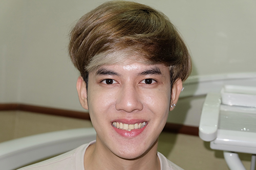 ก่อนทำวีเนียร์